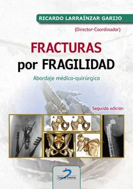 Fracturas por Fragilidad 2 Edicion