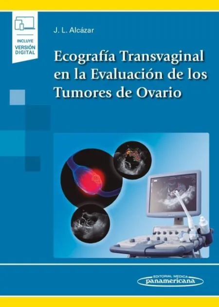Ecografía Transvaginal en la Evaluación de los Tumores de Ovario (Incluye Versió