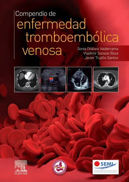 Compendio de Enfermedad Troboembolica Venosa