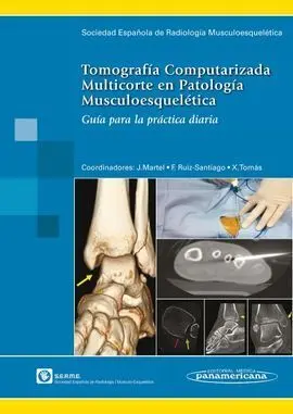 Tomografía Computarizada Multicorte en Patología Musculoesquelética