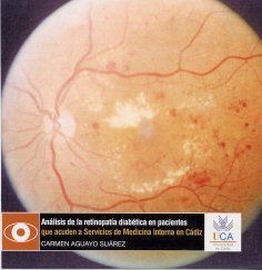 ANÃLISIS DE LA RETINOPATÃA DIABÃTICA EN PACIENTES QUE ACUDEN A SERVICIOS DE MEDICINA INTERNA EN CÃDI