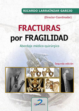 FRACTURAS POR FRAGILIDAD 2 EDICION