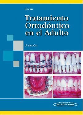 TRATAMIENTO ORTODONCICO EN EL ADULTO